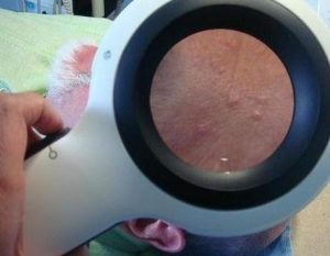 Skinlite Treatment