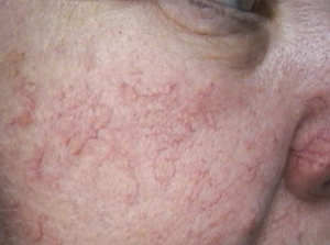 Lamprobe Treatment