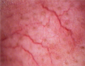 Cryoskin Treatment