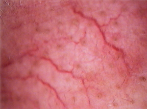 Cryoskin Treatment