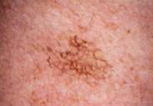 Lamprobe Treatment
