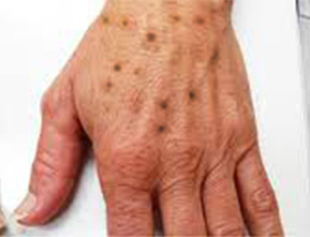 Effective Treatmentcryoskin Befor