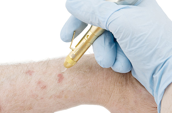 Lamprobe Treatment