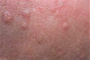 Sebaceous Hyperplasia treatment