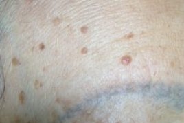 spider naevi treatment