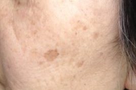 spider naevi treatment