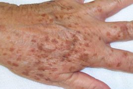 spider naevi treatment