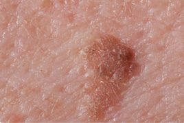 spider naevi treatment